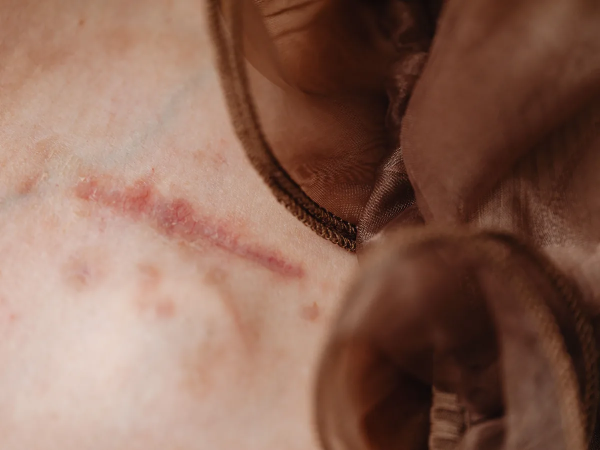 Detailed close-up of human skin revealing a surgical scar, skin texture, and fabric detail.