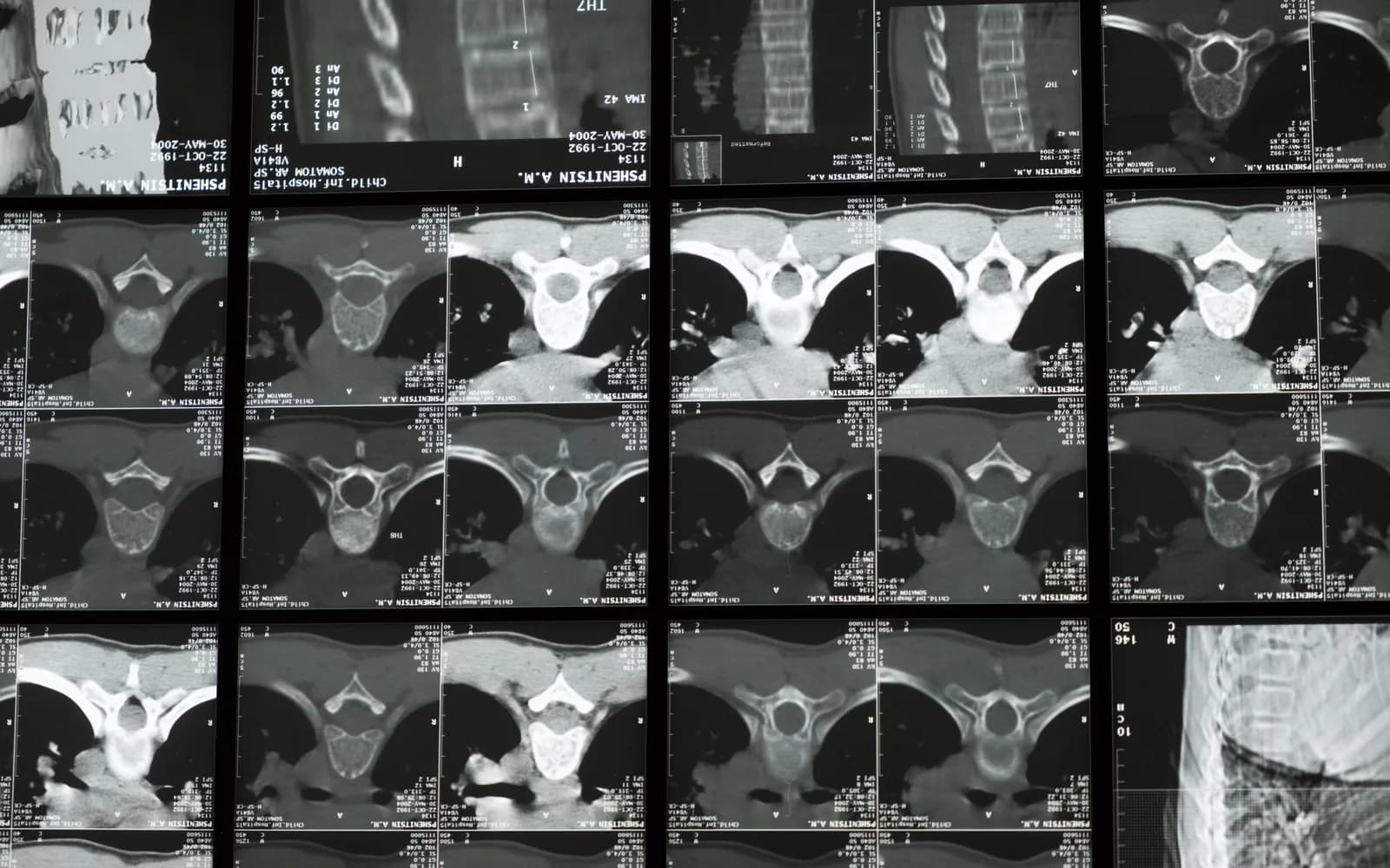 Radiological images of the human spine