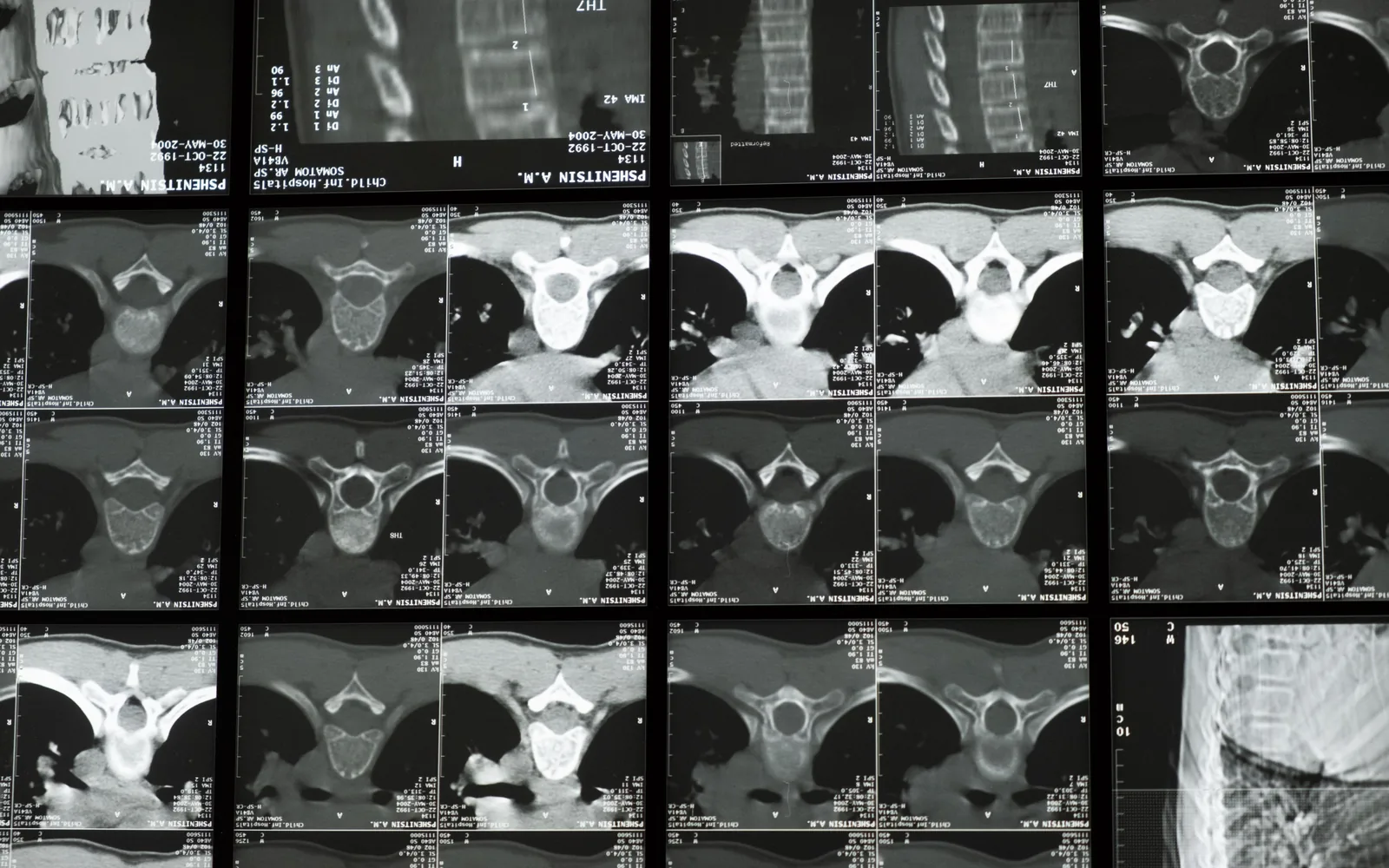 Radiological images of the human spine